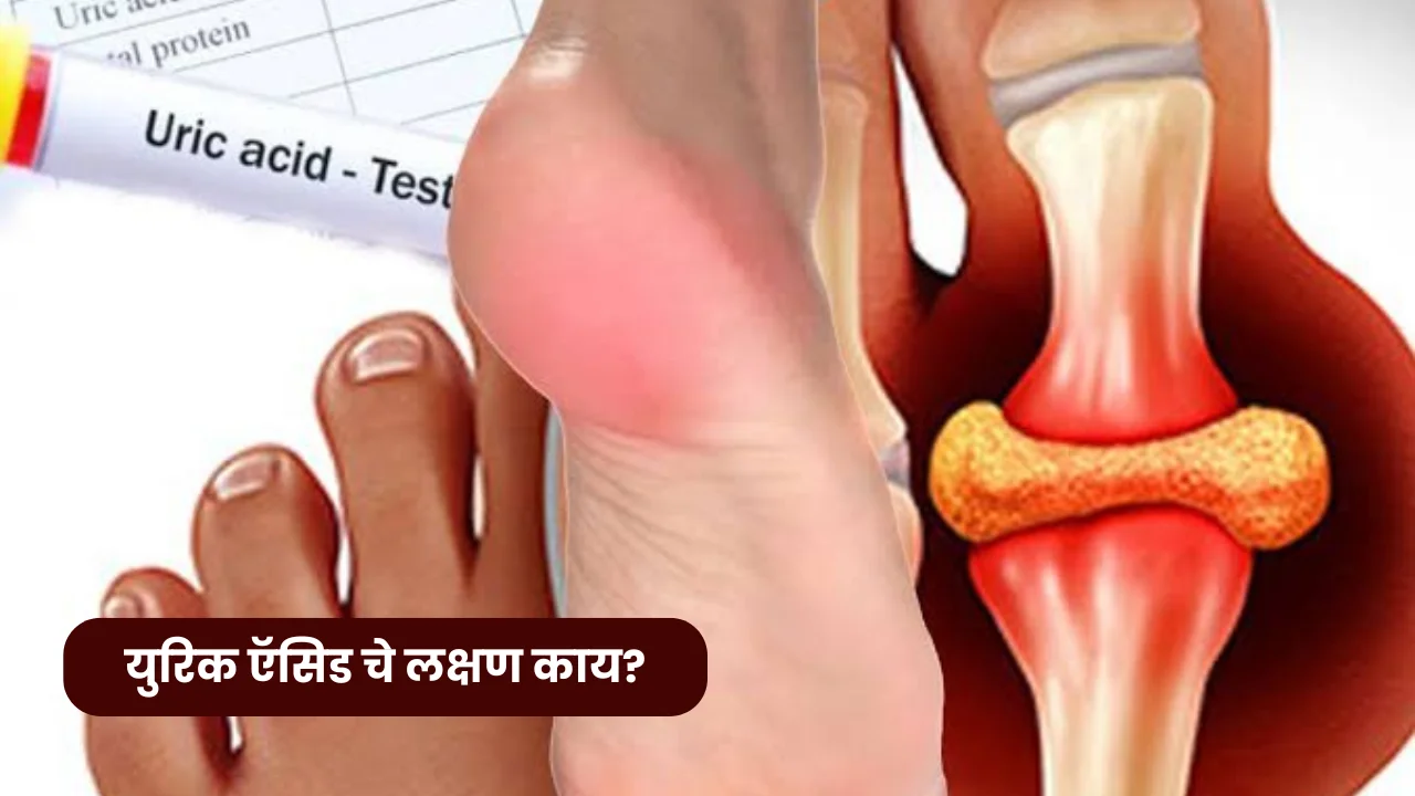 Symptoms of uric acid